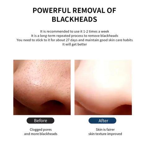 Cell Operated Pore Cleaner, Acne Tool Blackhead Remover, Nose Cleansing Beauty Instrument-Bazar Bulk